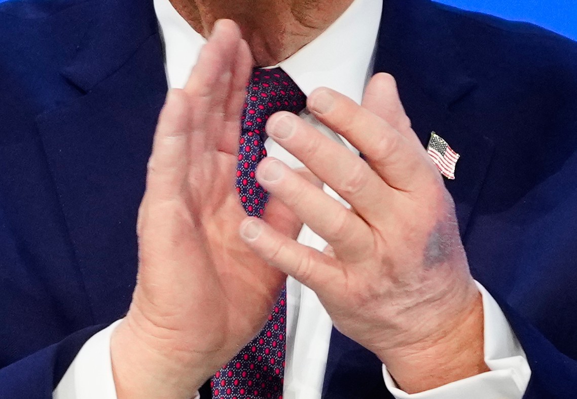 Trump Attributes New Hand Bruises to High-Dose Aspirin and Table Clipping