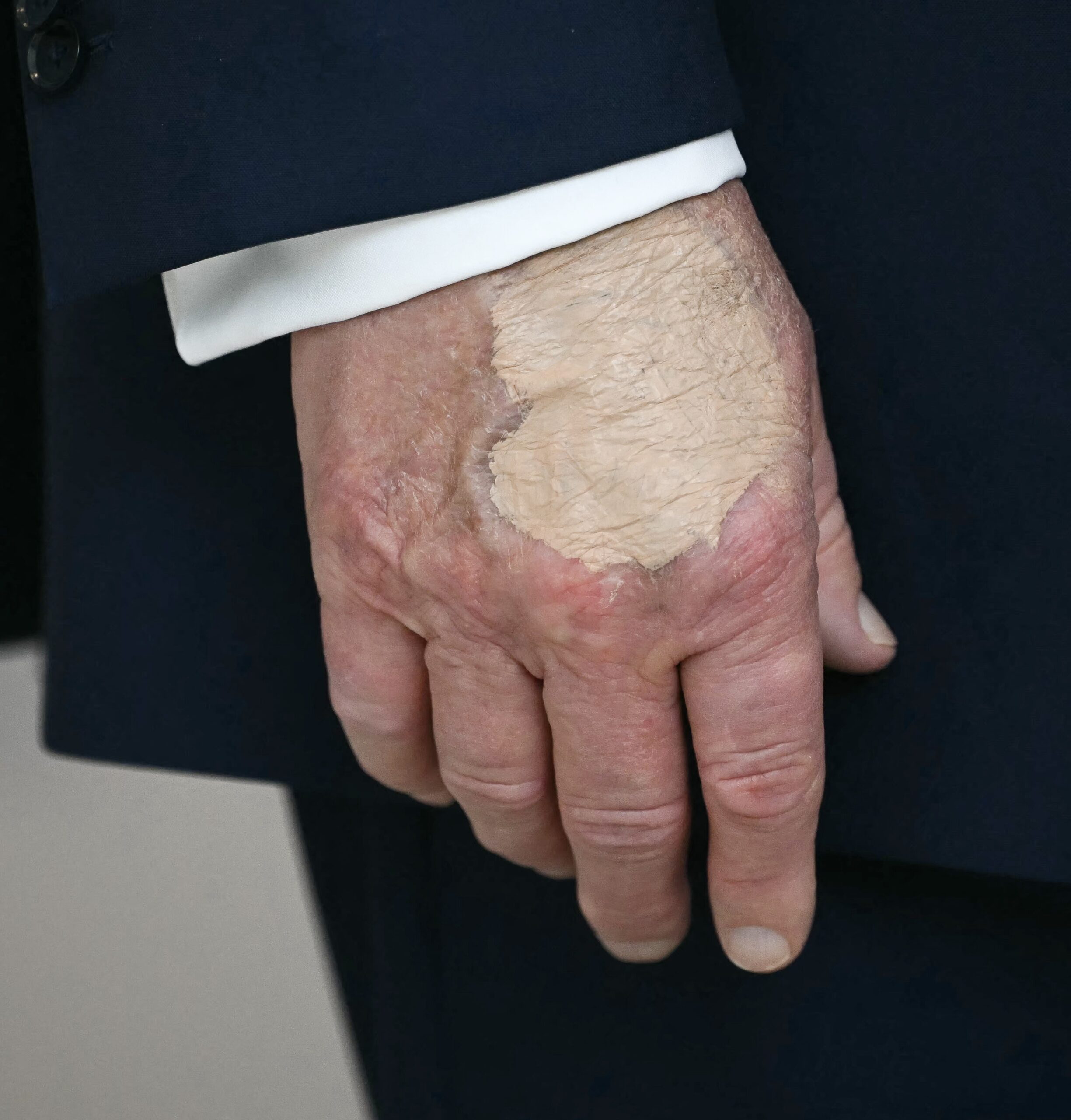 Trump Reveals Aspirin Overdose Causes Hand Bruises