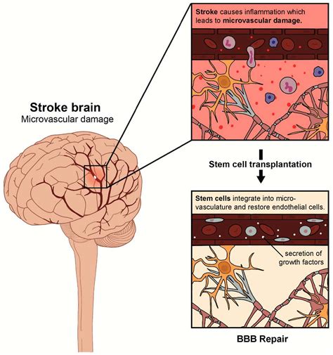 Groundbreaking Study Shows Stroke Damage Reversal Through Stem Cell Therapy